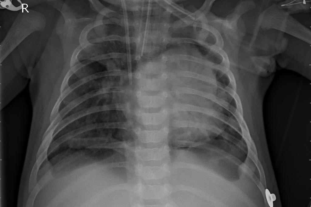 Additional pneumonia chest X-ray sample